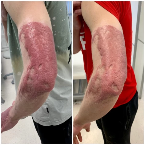 “Man pat nepatīk, ka piemin manas traumas, ka uzskata, ka pēc pārciestā sprādziena esmu izņēmums, ka mani var pažēlot! Nē, es to esmu aizmirsis, man tas ir pagājis etaps, mani nevajag žēlot. Jo pretinieks laukumā mani nežēlos un nespēlēs pret mani saudzīgāk tikai tāpēc, ka esmu ar plašiem ķermeņa apdegumiem,” uzsver Dāvids Vīksne.