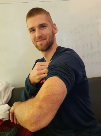 Tāds izskatījās Dāvida elkonis, kad viņš atsāka trenēties basketbolā, bet nu tikai zinātājs pamanīs apdeguma rētas. “Man šīs rētas netraucē. Es taču esmu vīrietis! Turklāt jau esmu aizmirsis, ka pirms četriem gadiem cietu sprādzienā. Atceros tikai, kad paskatos uz rētu klātajām rokām.”