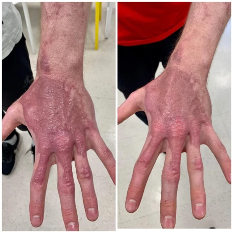 Pirmajā gadā, atsākot spēlēt basketbolu, Dāvida apdegušās plaukstas sāpēja pēc katra pieskāriena, bet tagad rētas vairs neliek sevi manīt. “Viss ir kārtībā, izskatās tikai pēc veca cilvēka rokām,” pasmejas puisis.