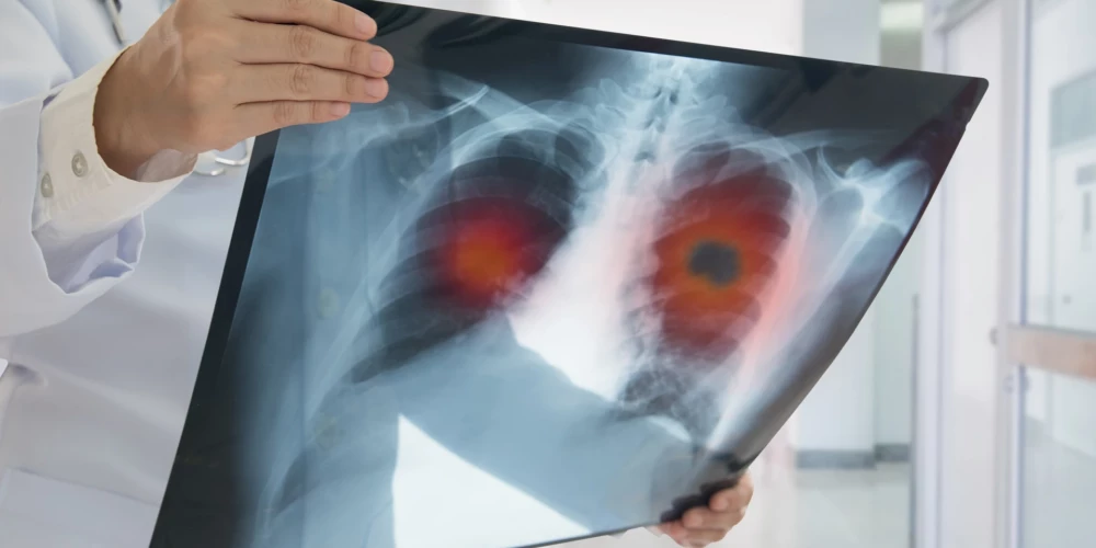 Visizplatītākais vēža izraisītas nāves cēlonis  - plaušu vēzis! Ko atklāj Eiropas vēža uzveikšanas plāns?