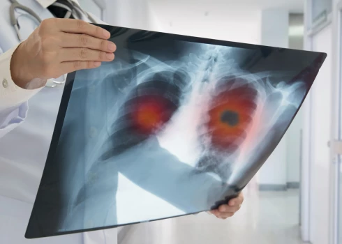 Visizplatītākais vēža izraisītas nāves cēlonis  - plaušu vēzis! Ko atklāj Eiropas vēža uzveikšanas plāns?
