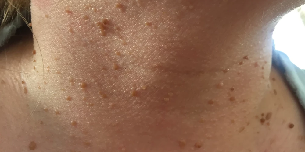 Kā tava āda signalizē par izmaiņām organismā?