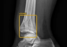 Rentgena attēlā ar mākslīgā intelekta palīdzību precizēts kājas lūzums. 
