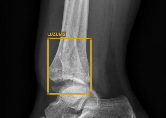 Vidzemes slimnīcā mākslīgais intelekts atpazīst kaulu lūzumus