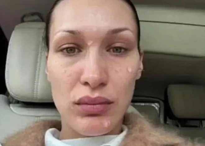 Лицо в волдырях и высыпаниях: Белла Хадид заявила, что ее "тошнит при виде себя"