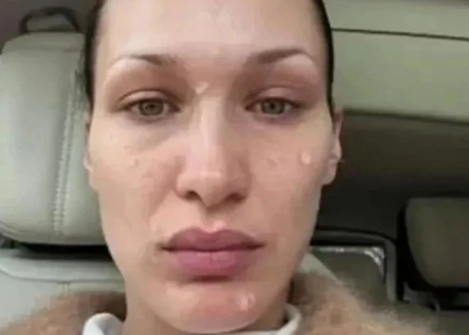 Seja vienos izsitumos: supermodelei Bellai Hadidai kļūst nelabi, pašai uz sevi skatoties