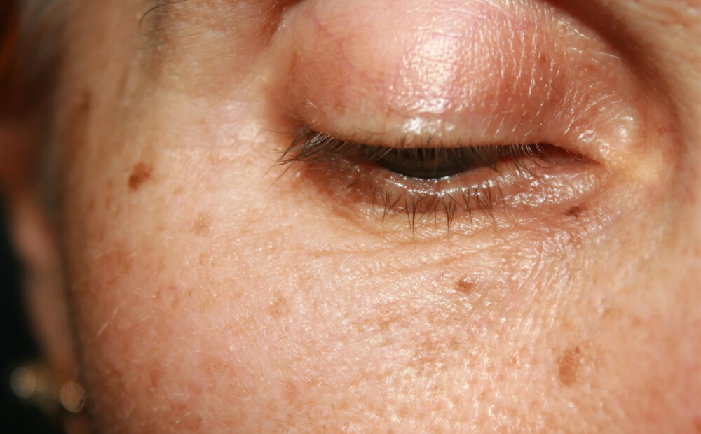 Maziņš plankumiņš zem sievietes acs izrādās pasaulē mazākais ādas vēzis