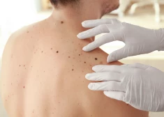 Dermatologs nosauc vecuma grupu, kurai ādas vēzi atklāj visbiežāk
