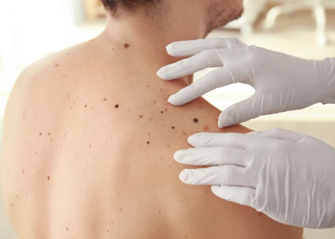 Dermatologs nosauc vecuma grupu, kurai ādas vēzi atklāj visbiežāk