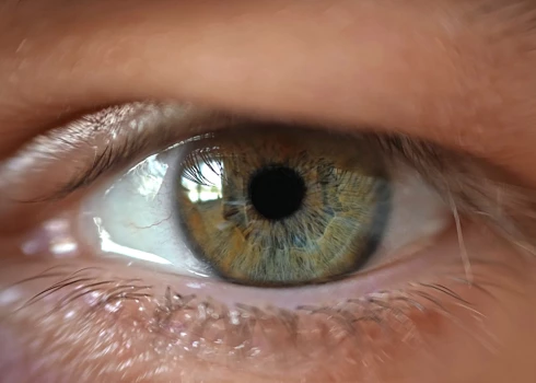 Bīstami augsta holesterīna līmeņa simptoms, ko var pamanīt acīs
