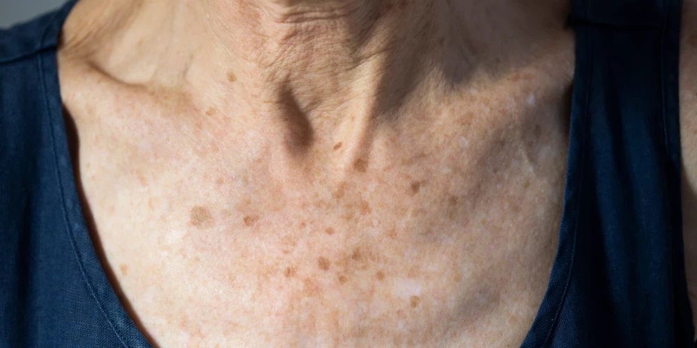 Kā atšķirt nekaitīgus vecuma pleķus no ādas vēža?