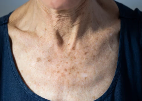Kā atšķirt nekaitīgus vecuma pleķus no ādas vēža?