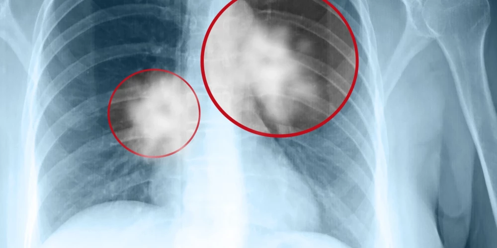 8 mazāk zināmas plaušu vēža pazīmes, kas jāzina, lai ļauno slimību pamanītu laikus