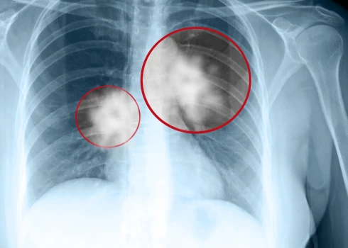 8 mazāk zināmas plaušu vēža pazīmes, kas jāzina, lai ļauno slimību pamanītu laikus