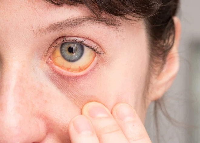 Dzēriens, kas saistīs ar aknu vēzi un citām smagām kaitēm