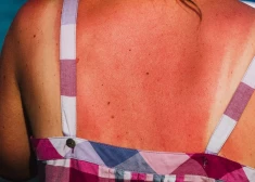 Kāpēc uz saules apdedzinātas ādas nedrīkst smērēt krējumu vai eļļu?