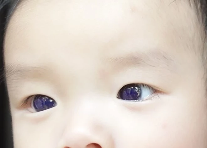 Глаза 6-месячного ребенка стали фиолетовыми после приема лекарства от Covid-19
