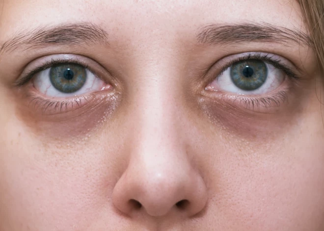 Izteiktākie simptomi, kas var liecināt par folijskābes trūkumu organismā