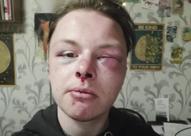 Policija atklāj jaunu informāciju par LGBT kopienas pārstāvja smago piekaušanu Daugavpilī