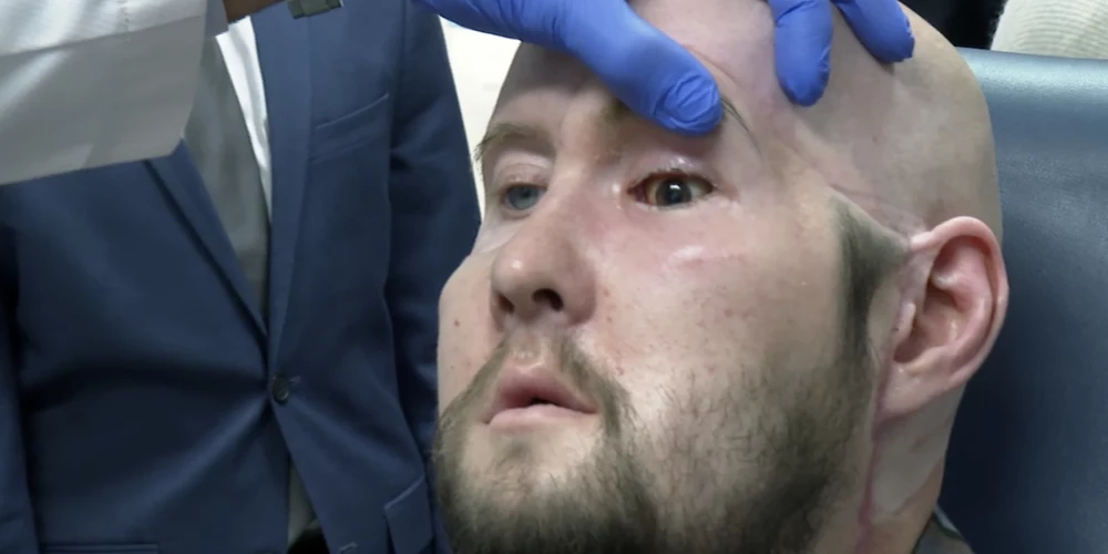 Veikta pasaulē pirmā acs transplantācija dzīvam cilvēkam