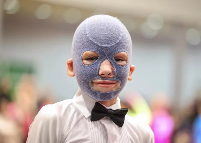 Astoņus gadus vecais Romāns Oleksivs ir uzreiz atpazīstams starp bērniem Ļvovas skolas gaiteņos, jo Krievijas armijas raķetes triecienā gūto apdegumu dēļ viņš valkā zilu masku uz balvas un speciālus cimdus uz rokām. Pēc smagajiem ievainojumiem un atlabšanas Romāns ir atgriezies skolā Ukrainas rietumu pilsētā Ļvovā un atsācis deju nodarbības, vēsta “Reuters”. Romāns ir piedzīvojis brīnumainu atlabšanu no dzīvībai bīstamiem apdegumiem un galvas šķembām.