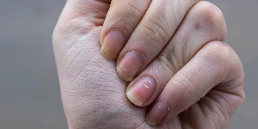 Piecas pazīmes uz taviem nagiem, kas var liecināt par veselības problēmām