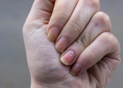 Piecas pazīmes uz taviem nagiem, kas var liecināt par veselības problēmām