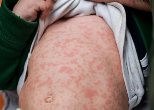 Aizvadītajā gadā Eiropā vairāk nekā 30 reizes pieaudzis masalu gadījumu skaits.