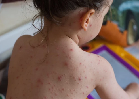 2023. gadā 45 reizes palielinājies masalu gadījumu skaits Eiropā.