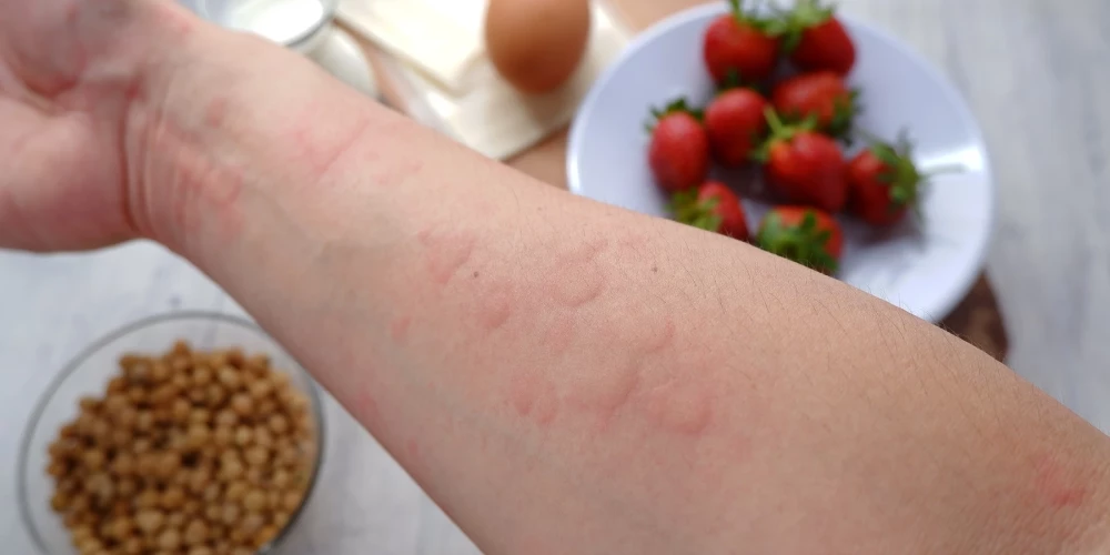 Kā atšķirt pārtikas alerģiju no nepanesības?