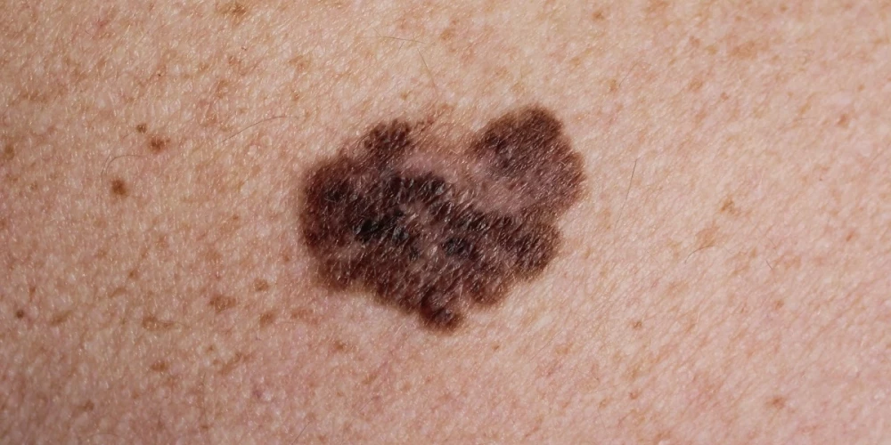 Dermatologs: atpazīstot šo brūno plankumu uz ādas, vari izglābt sev dzīvību