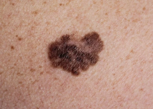 Dermatologs: atpazīstot šo brūno plankumu uz ādas, vari izglābt sev dzīvību