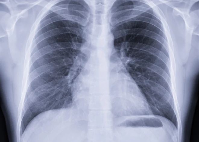 Divu mēnešu laikā 17 leģionāru slimības gadījumi! Kā atšķirt tās simptomus no parastas saaukstēšanās?