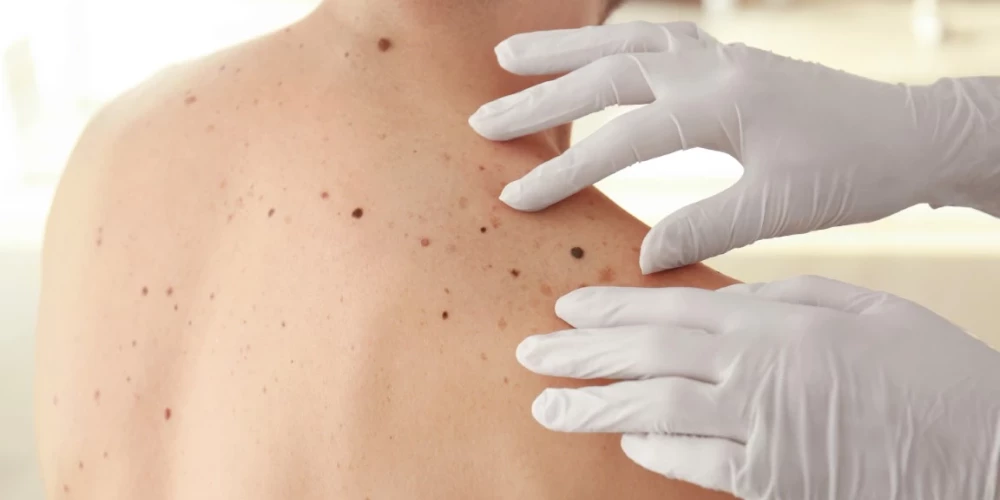 Kam ir paaugstināts risks saslimt ar melanomu?