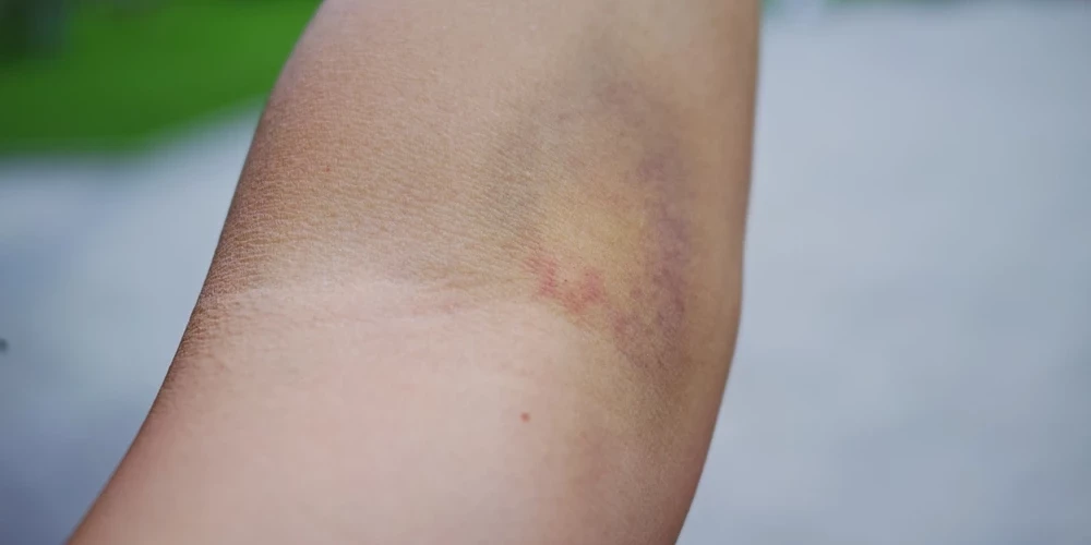 Очень важно знать, какие признаки говорят о появлении тромбов.