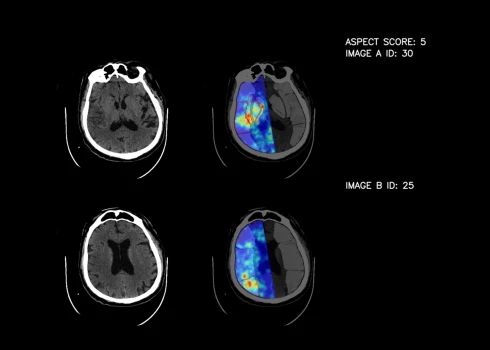 Latvijā radīts mākslīgā intelekta risinājums Stradiņa slimnīcas ārstiem palīdzēs atpazīt insultu
