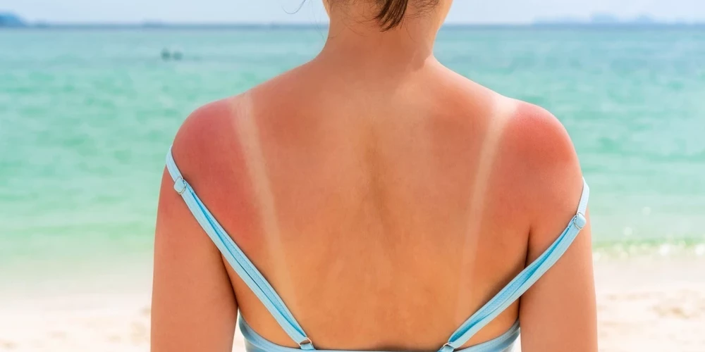 На солнце может обгореть любая часть тела: 9 советов к действию