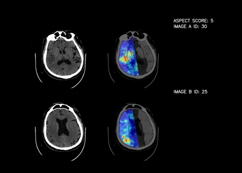 Latvijā radīts mākslīgā intelekta risinājums ārstiem palīdzēs atpazīt insultu.