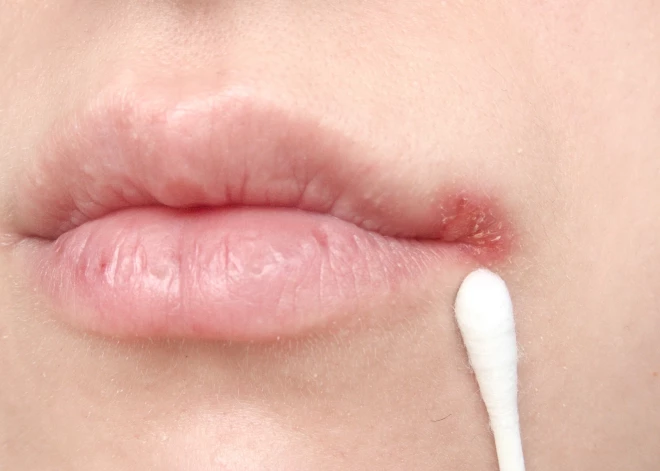 Sasprēgājuši lūpu kaktiņi: cik nopietna ir šī problēma?