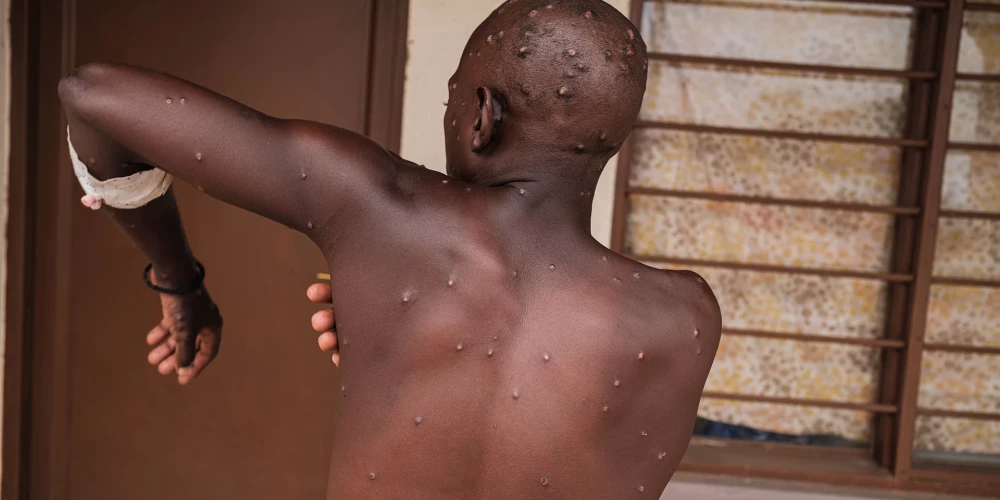 Pērtiķu baku inficētā pacienta galvu un ķermeni klāj izsitumi. Viņš atlabst slimnīcā Burundi.