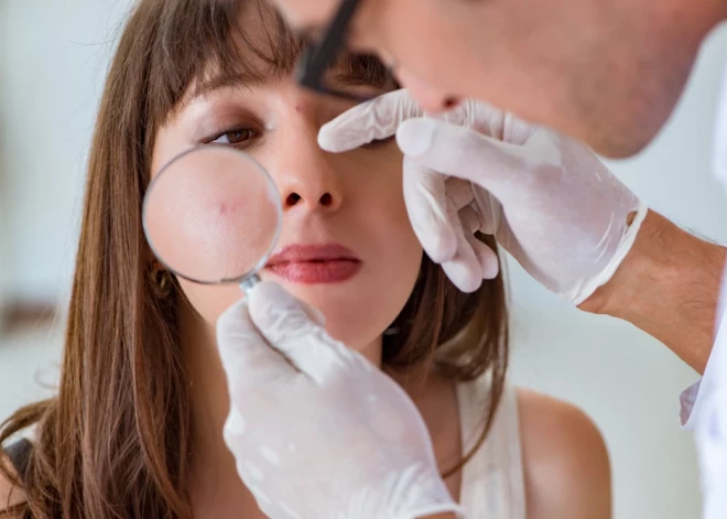 Kas jāzina par ādas pigmentāciju un veidojumiem – rudens ir labākais laiks tos likvidēt