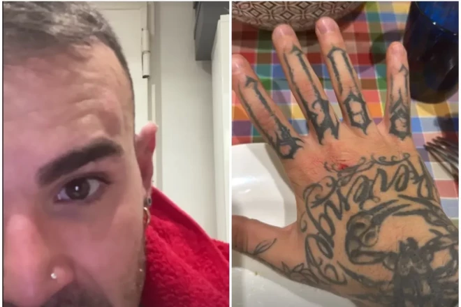 Nikola Bartolīni uzbrukuma atmiņas ir puns uz pieres un no sitieniem noberztā roka.