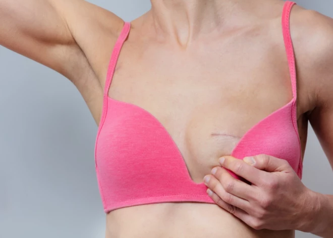 Negaidīti atceltas 40 valsts apmaksātās krūts rekonstrukcijas operācijas