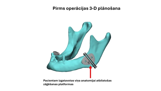 Pacientam tika izgatavota individuāla zāģēšanas platforma, lai anatomiski precīzāk atjaunotu izņemto apakšžokli.