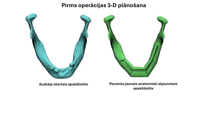 Audzēja metastāzes tika atrastas jau kakla limfmezglos.