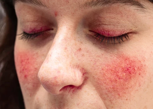 Pirmās kuperozes pazīmes parasti cilvēki sāk manīt ap 30 gadu vecumu. Ja nekas netiek darīts lietas labā, pēc 35 gadu vecuma šīs pazīmes jau kļūst arvien izteiktākas, var veidoties rozācija.