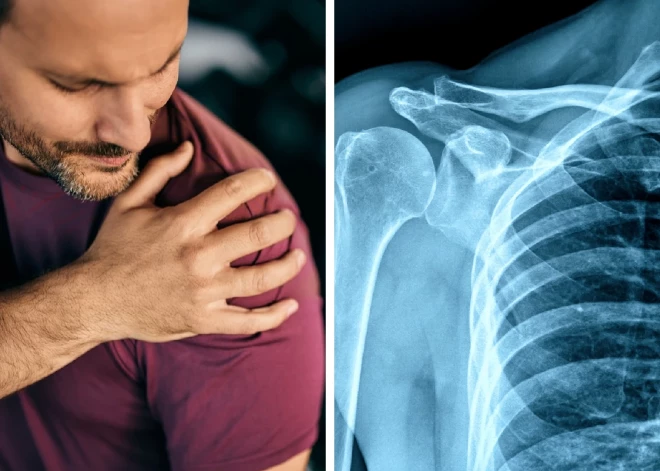 Kā ārstēt sasaldētu plecu? Stāsta ortopēds Andrejs Peredistijs