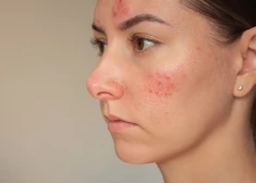 Vai psoriāzi var izārstēt? Atbild dermatoloģe Elīza Sālījuma