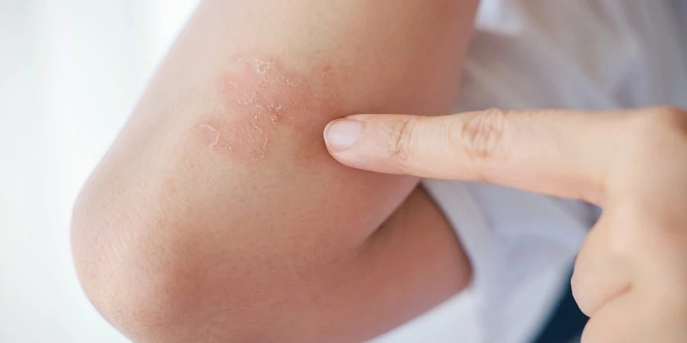 Psoriāze (latīņu: psoriasis vulgaris) ir hroniska autoimūna ādas slimība. To mēdz saukt arī par zvīņēdi. Tai ir raksturīgi labi norobežoti, virs ādas nedaudz pacelti iekaisīgi sārti izsitumi, ko klāj sudrabaini balts, viegli nokasāms aplikums, kas atgādina zvīņas. Izsitumus pavada izteikta nieze. Parasti izsitumi lokalizējas uz elkoņu un ceļu locītavām, uz galvas gar matu augšanas līniju, krustu apvidū.