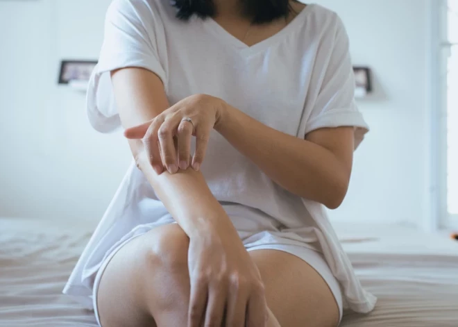 Врачи приглашают записаться на бесплатную диагностику псориаза в Риге